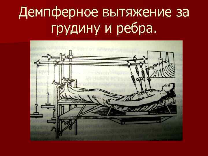 Демпферное вытяжение за грудину и ребра. 