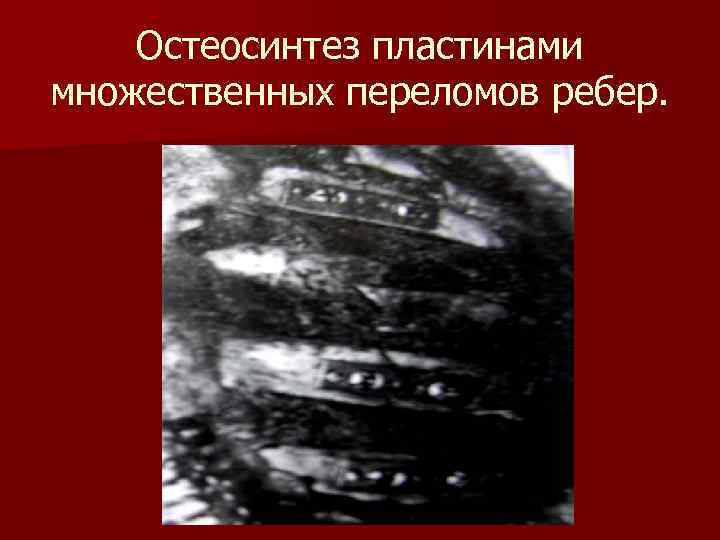 Остеосинтез пластинами множественных переломов ребер. 
