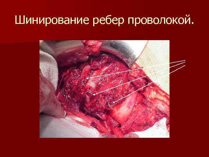 Шинирование ребер проволокой. 