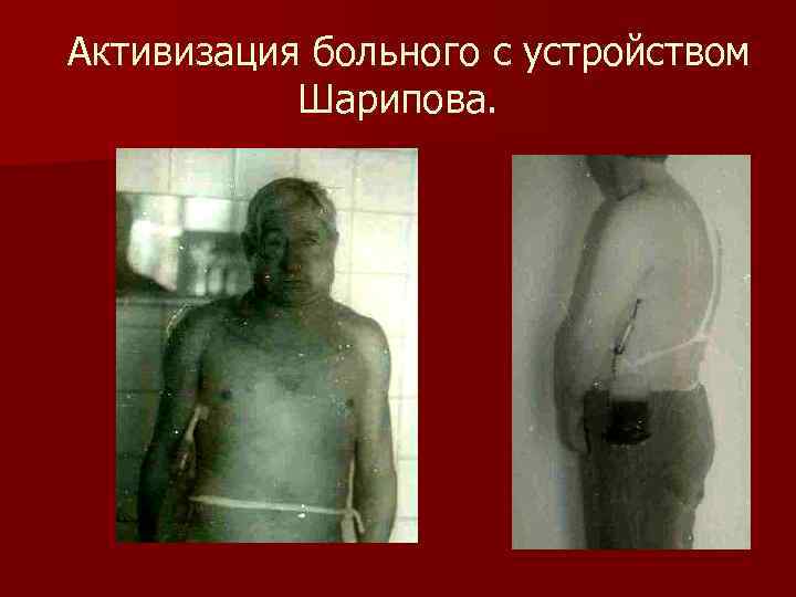Активизация больного с устройством Шарипова. 