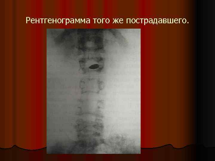 Рентгенограмма того же пострадавшего. 