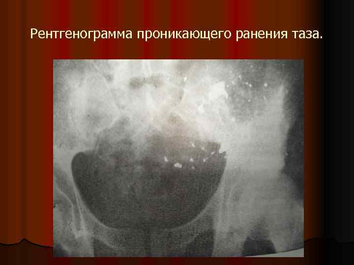 Рентгенограмма проникающего ранения таза. 