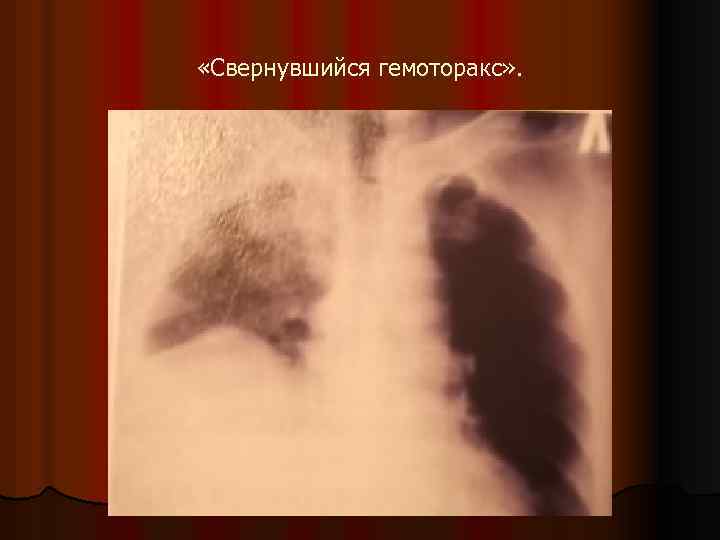  «Свернувшийся гемоторакс» . 