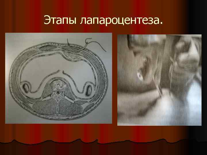 Этапы лапароцентеза. 