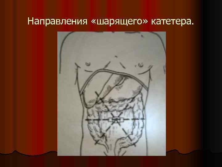 Направления «шарящего» катетера. 
