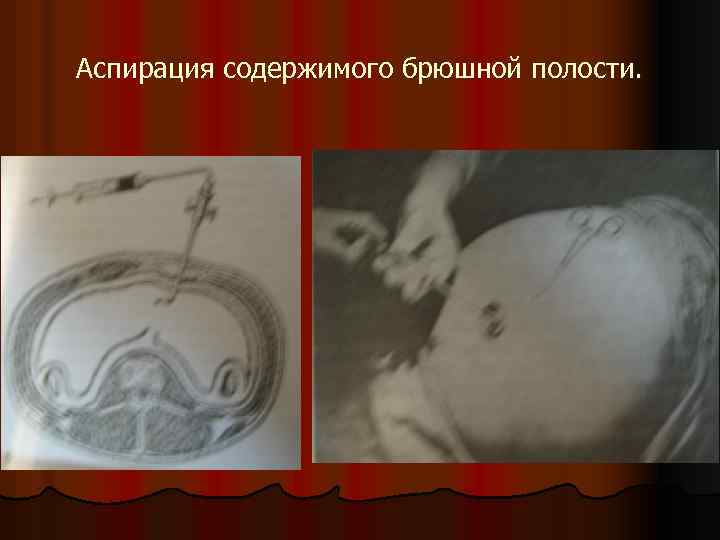 Аспирация содержимого брюшной полости. 