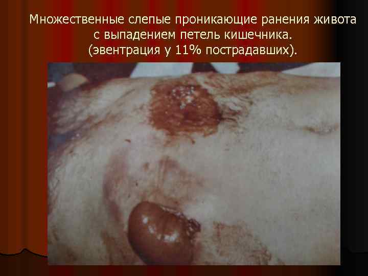 Множественные слепые проникающие ранения живота с выпадением петель кишечника. (эвентрация у 11% пострадавших). 