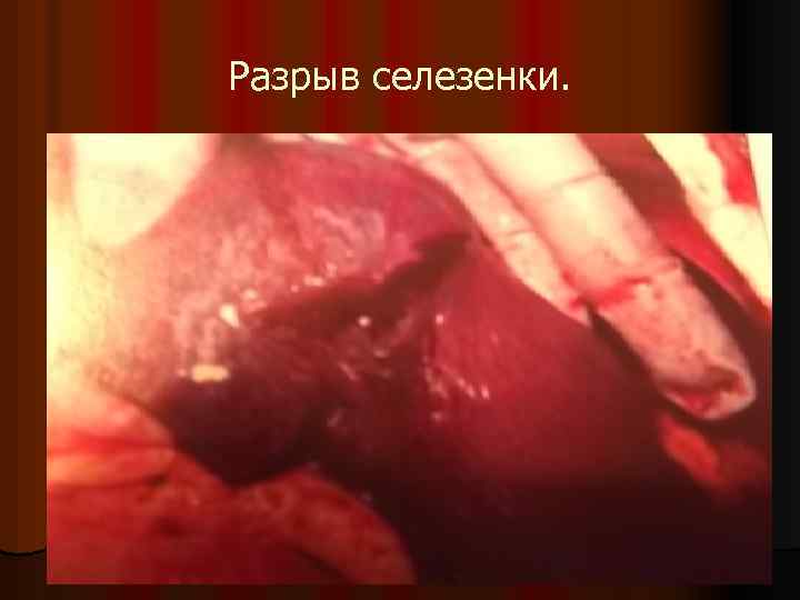Разрыв селезенки. 