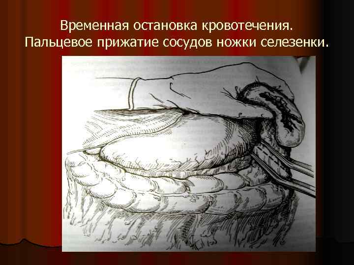 Временная остановка кровотечения. Пальцевое прижатие сосудов ножки селезенки. 
