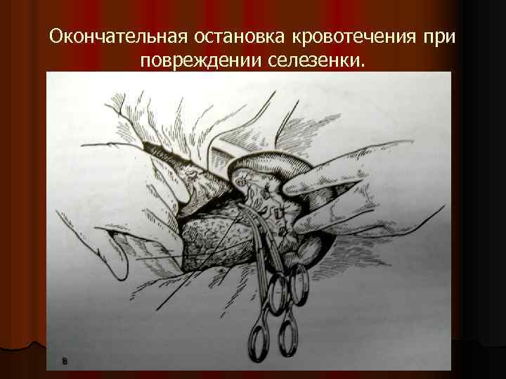Окончательная остановка кровотечения при повреждении селезенки. 