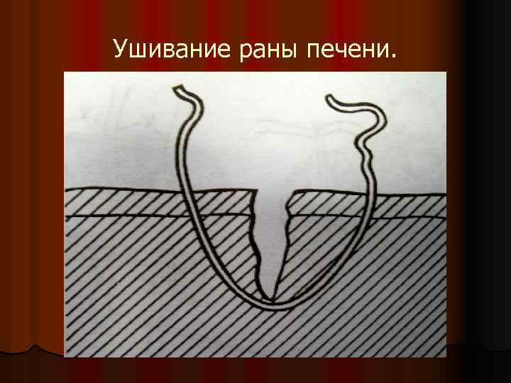Ушивание раны печени. 