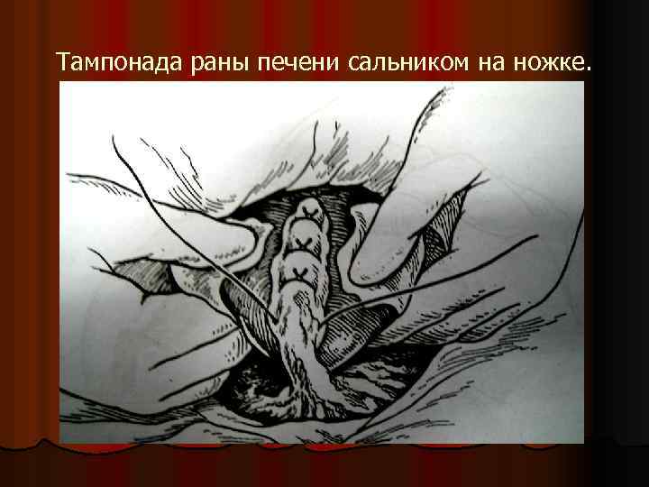 Тампонада раны печени сальником на ножке. 