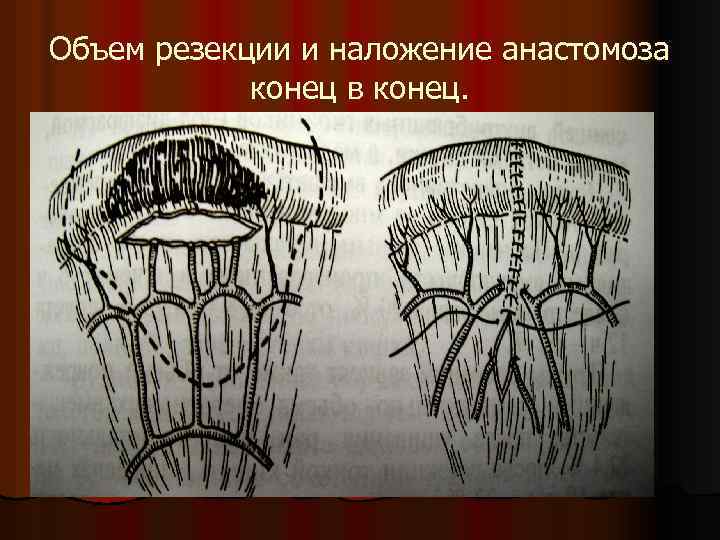 Объем резекции и наложение анастомоза конец в конец. 