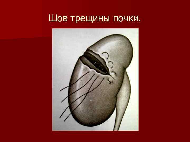 Шов трещины почки. 