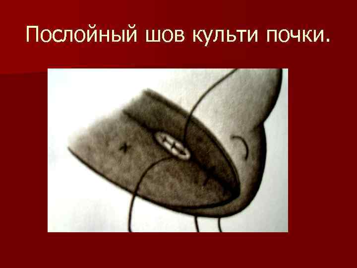 Послойный шов культи почки. 