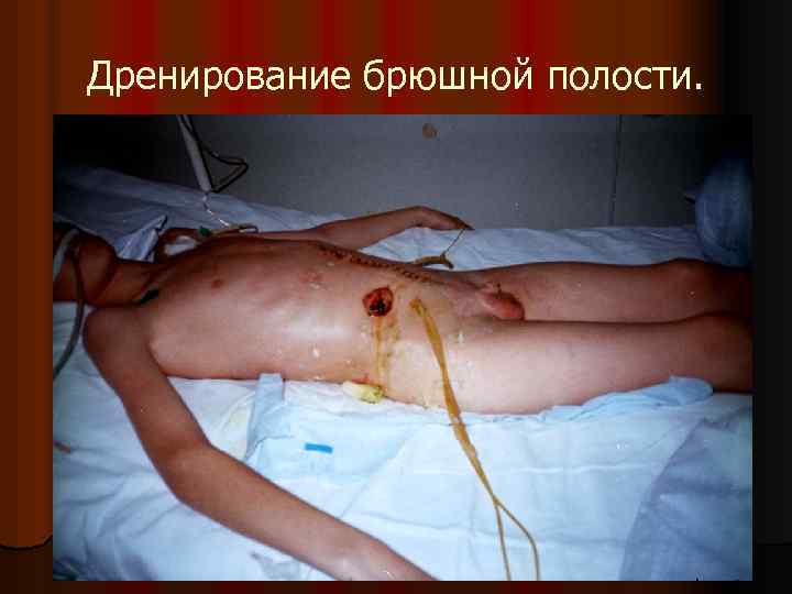 Дренирование брюшной полости. 