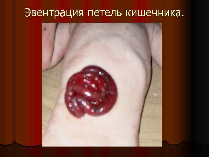 Эвентрация петель кишечника. 