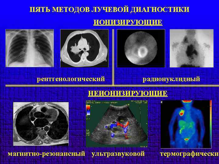 ПЯТЬ МЕТОДОВ ЛУЧЕВОЙ ДИАГНОСТИКИ ИОНИЗИРУЮЩИЕ рентгенологический радионуклидный НЕИОНИЗИРУЮЩИЕ магнитно-резонансный ультразвуковой термографический 