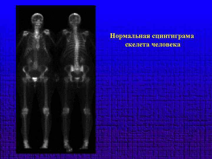 Нормальная сцинтиграма скелета человека 