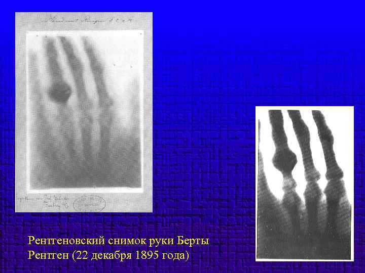 Рентгеновский снимок руки Берты Рентген (22 декабря 1895 года) 