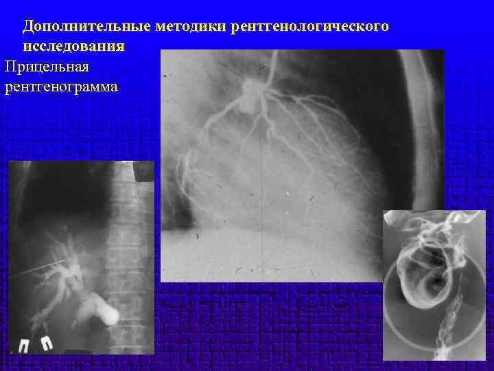 Дополнительные методики рентгенологического исследования Прицельная рентгенограмма 