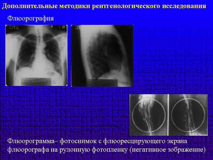 Дополнительные методики рентгенологического исследования Флюорография Флюорограмма– фотоснимок с флюоресцирующего экрана флюорографа на рулонную фотопленку