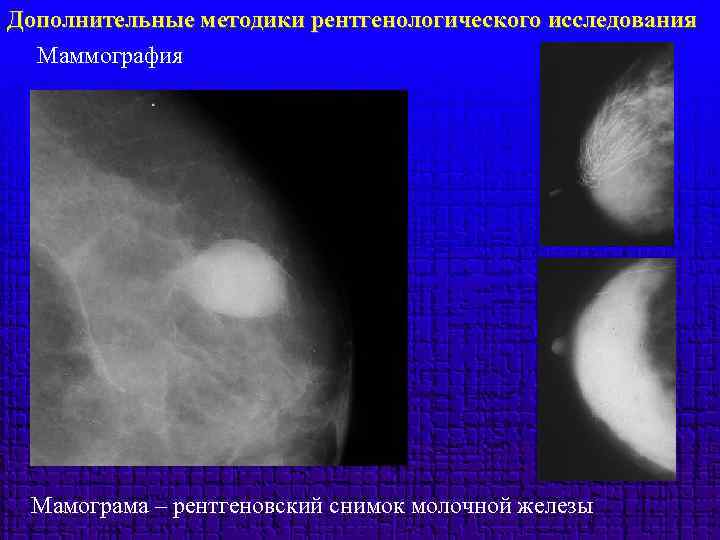 Дополнительные методики рентгенологического исследования Маммография Мамограма – рентгеновский снимок молочной железы 