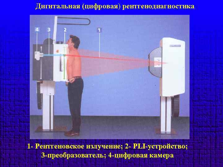 Дигитальная (цифровая) рентгенодиагностика 1 - Рентгеновское излучение; 2 - PLI-устройство; 3 -преобразователь; 4 -цифровая