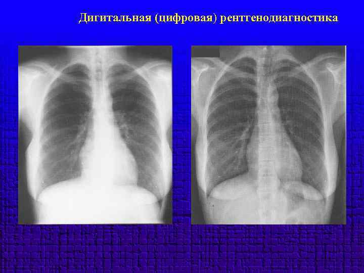 Дигитальная (цифровая) рентгенодиагностика 