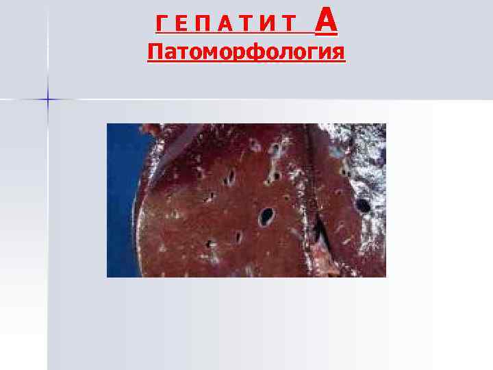 ГЕПАТИТ А Патоморфология 