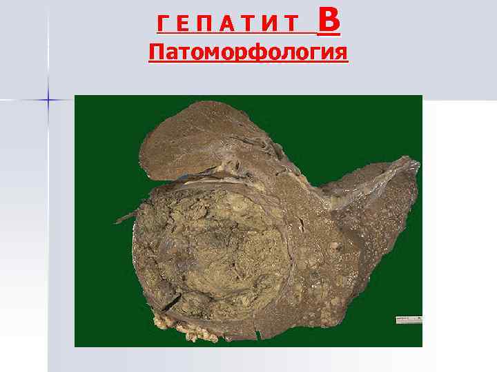 ГЕПАТИТ В Патоморфология 
