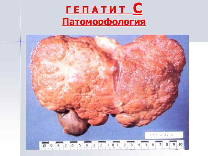 ГЕПАТИТ С Патоморфология 