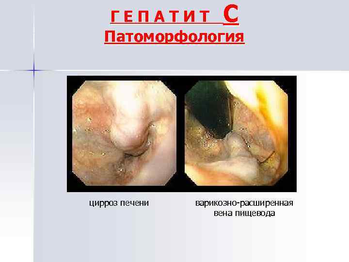 ГЕПАТИТ С Патоморфология цирроз печени варикозно расширенная вена пищевода 