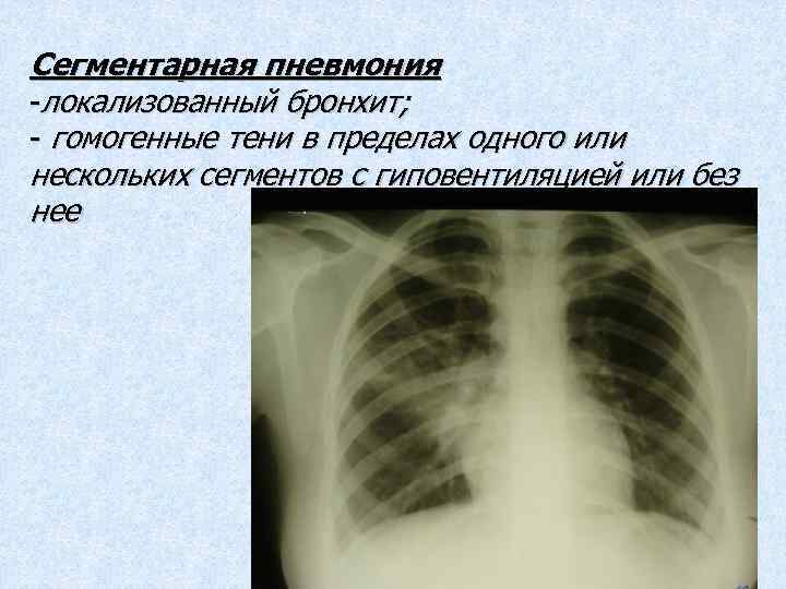 Сегментарная пневмония. Левосторонняя полисегментарная пневмония рентген. Правосторонняя сегментарная пневмония s2,. Моносегментарная пневмония. Очаговая сегментарная пневмония.