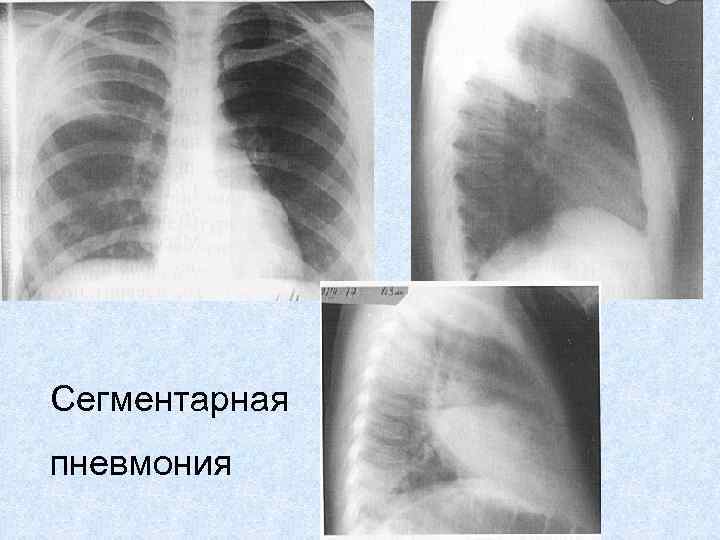 Сегментарная пневмония у детей что это