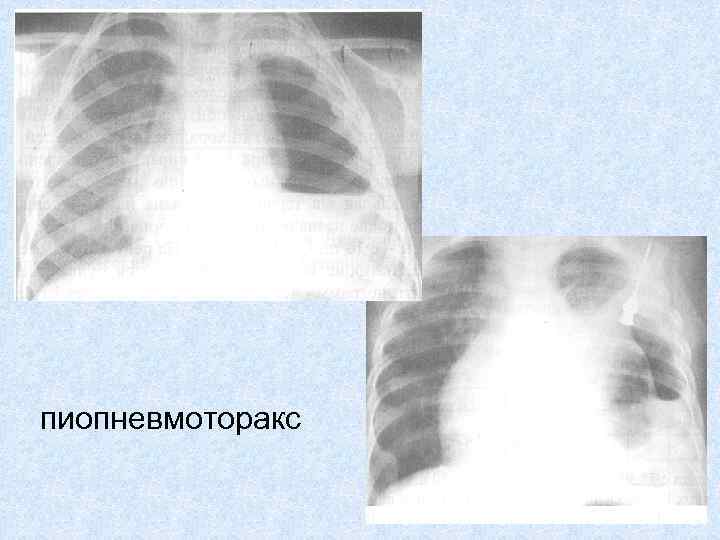 На рентгенологической картине напряженного пиопневмоторакса отмечается смещение средостения в