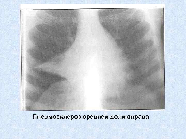 Диффузный пневмосклероз это рак. Пневмосклероз рентген признаки. Постпневмонический пневмосклероз. Перибронхитический пневмосклероз. Очаговый пневмосклероз рентген.