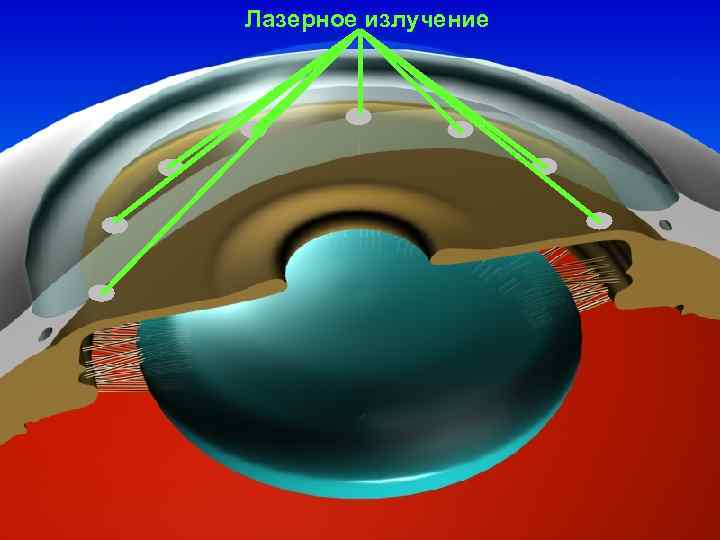 Лазерное излучение 