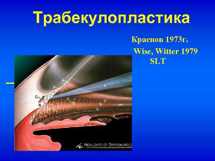 Трабекулопластика Краснов 1973 г. Wise, Witter 1979 SLT 