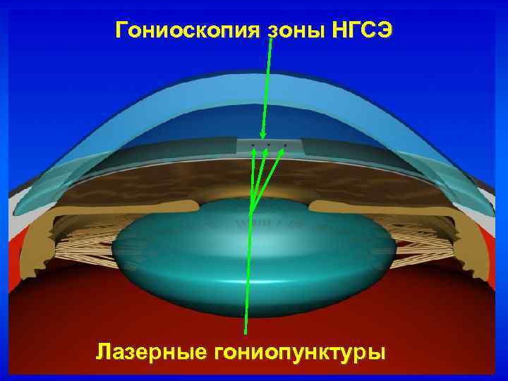 Гониоскопия зоны НГСЭ Лазерные гониопунктуры 