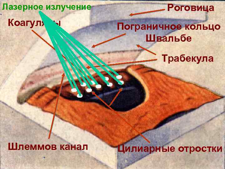 Лазерное излучение Коагуляты Роговица Пограничное кольцо Швальбе Трабекула Шлеммов канал Цилиарные отростки 