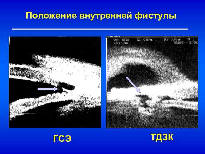 Положение внутренней фистулы ГСЭ ТДЗК 