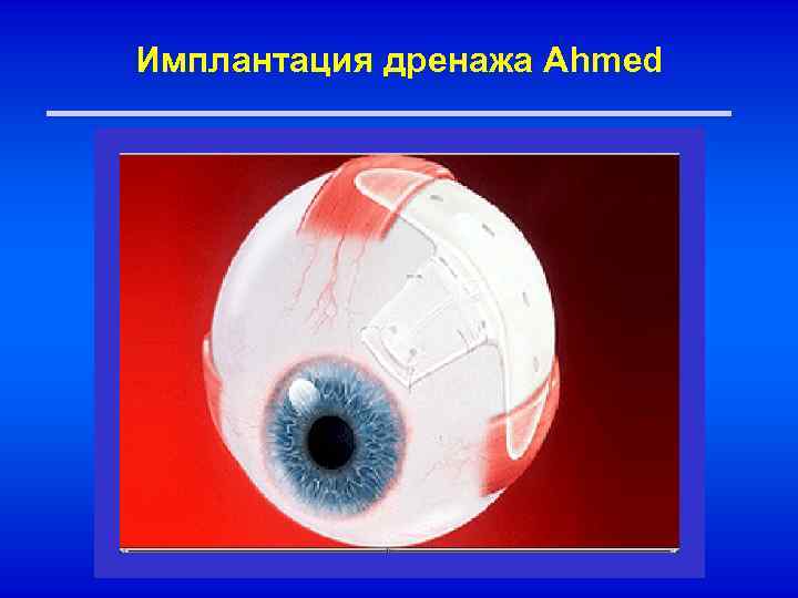 Имплантация дренажа Ahmed 