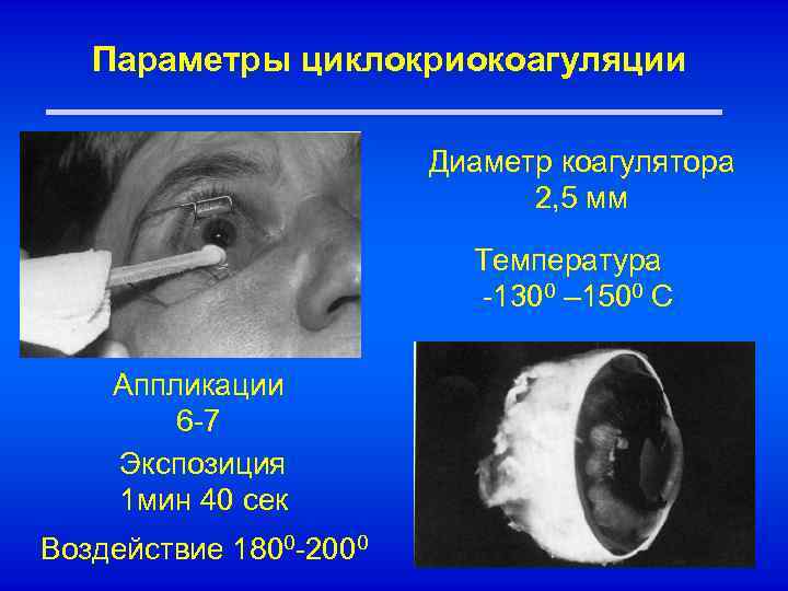 Параметры циклокриокоагуляции Диаметр коагулятора 2, 5 мм Температура -1300 – 1500 С Аппликации 6