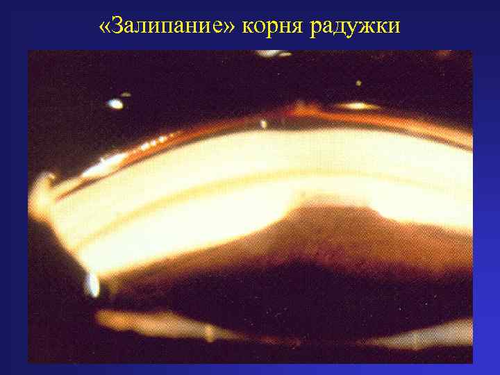 «Залипание» корня радужки 