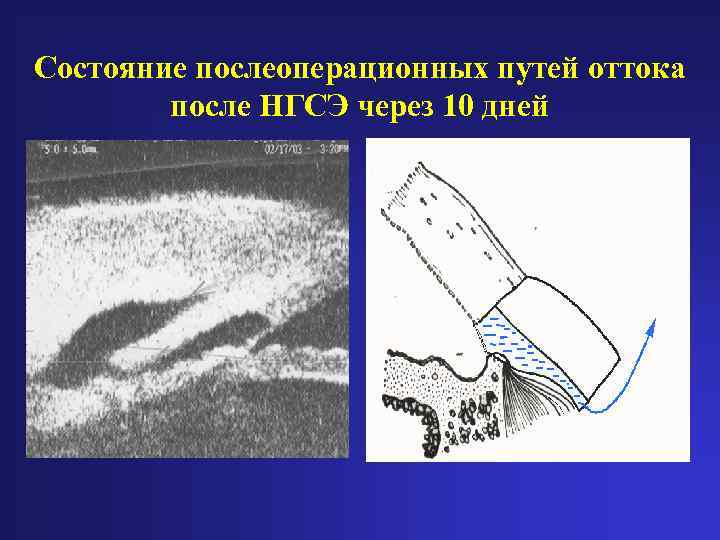 Состояние послеоперационных путей оттока после НГСЭ через 10 дней 