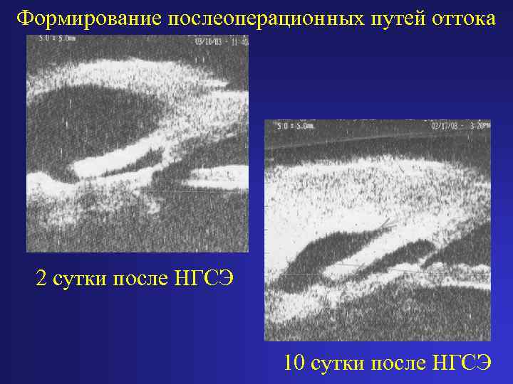 Формирование послеоперационных путей оттока 2 сутки после НГСЭ 10 сутки после НГСЭ 
