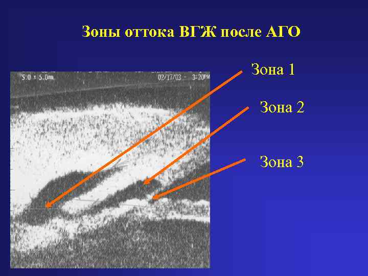 Зоны оттока ВГЖ после АГО Зона 1 Зона 2 Зона 3 