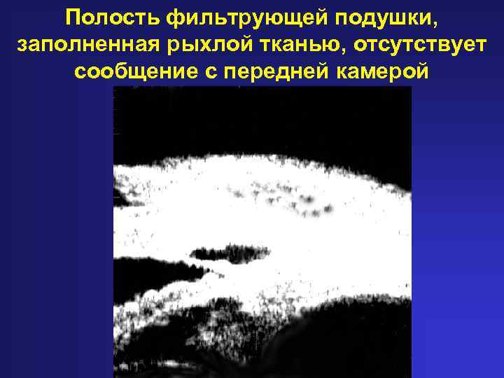 Полость фильтрующей подушки, заполненная рыхлой тканью, отсутствует сообщение с передней камерой 