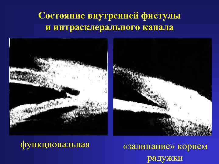 Состояние внутренней фистулы и интрасклерального канала функциональная «залипание» корнем радужки 